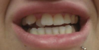 Braces for teeth: My teeth